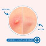 KEYCONCEPTS Pimple Patches for Face (120 Patches), Hydrocolloid Acne Patches with Tea Tree Oil - Pimple Patch Zit Patch and Pimple Stickers - Hydrocolloid Acne Dots for Acne - Zit Patches - Image 3